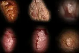 【多图预警】尖锐湿疣有什么症状？三分钟让你快速分辨！图片