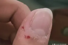 手上倒刺反复长，不是缺维生素！而是……图片