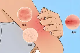 痒痒痒！湿疹反复发作，药物治疗怎么选？图片