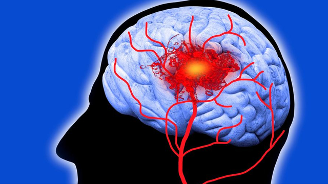 脑梗去世的人越来越多？医生劝告：天冷宁可喝凉水	，也别做这3事
