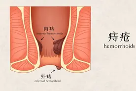 ‘十人九痔’现象普遍，内热是祸首；两味中成药，有效缓解痔疮图片