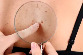 长了扁平疣，该如何“消灭”它？这8个方法，你不妨试试！图片