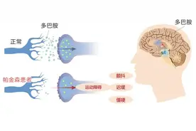 数钱数到“手抽筋”，要小心这个病图片