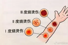 女员工飞奔关热水被烫伤！！！这些烫伤应急小知识你都知道吗图片
