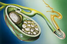 可乐和醋溶解胆结石和肾结石？图片