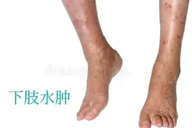 腿肿别乱揉！7种病因对照表，有人差点因疏忽丢了性命图片