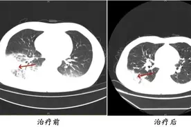 吹了3天空调，男子左肺“白”了一半！紧急提醒图片
