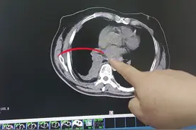 治疗肺癌需要花多少钱？图片