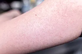 毛囊上很多小疙瘩，不敢露腿、露胳膊，“鸡皮肤”还有救吗？图片