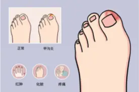 重庆大学附属仁济医院（市五院）科普丨甲沟炎：小问题，大麻烦！图片