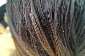 头皮屑比较多，是身体内部出问题了？医生：或是这3种病在作怪图片