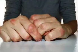 手上长小水泡、脱屑还奇痒，湿疹和手癣如何治疗？一文为你全说清图片