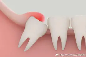 长智齿避免不了，但智齿发炎我们可以躲过！图片