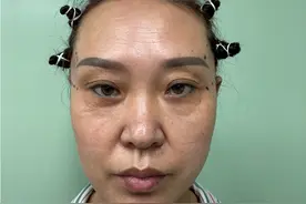 51岁拉皮手术一年后实拍，和想象中完全不同，真实经历大曝光！图片