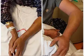 男子在家被毒蛇咬伤！救治6大误区别踩雷→图片