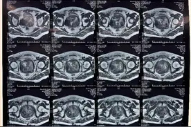 山西医科大学第一医院泌尿外科前列腺亚专业完成一例机器人辅助腹腔镜下巨大前列腺切除术图片