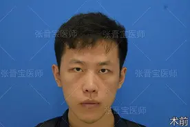 22岁男大学生，下定决心跨省把眼袋手术做了，术后：帅哥你谁啊！图片