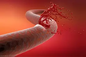 胆固醇高不自知？手脚出现四个信号・说明血管已严重堵塞！图片