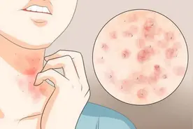 荨麻疹一挠一大片？还能写字？医生教你5个小方法，祛风止痒图片