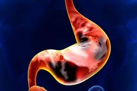 从“胃炎”到“胃癌”，大概需要几年呢？医生说出实情，早知早好图片