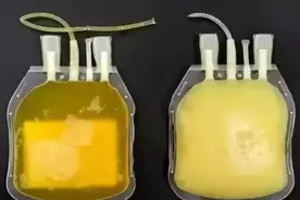 #健康素养提升V计划# 54岁男子尿毒症伴高乳糜血症！该如何治疗？图片