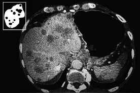 从肝硬化到肝癌，要多长时间？医生解释：出现3种情况肝癌已不远图片
