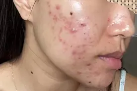 30天打卡实测祛痘膏！原来好用的都是国货，轻松告别痘痘痘印！图片