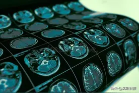 专家讲解如何预防脑血管病：积极筛查主动控制脑血管病危险因素图片