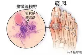 痛风结晶怎么才能消除？图片
