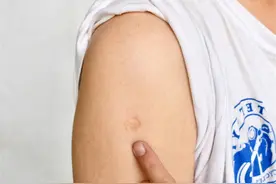 甄嬛传里的“肺痨”是什么病？现代它叫什么？图片