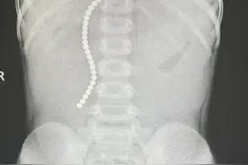 磁力珠又惹大祸！4岁女童当糖豆吞下，致多处肠穿孔抢救10天图片