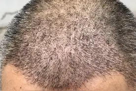 头皮银屑病，5种好用的外用药图片