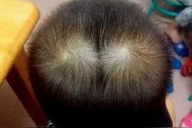 头顶两个旋的孩子智商更高？科学揭秘让家长震惊的真相！图片