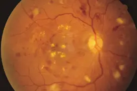 几种常见的眼底病、黄斑病变，oct检查图示说明图片