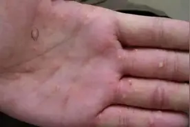 手上反复冒“小水泡”，是身体发出的警报？这3个诱因，建议了解图片