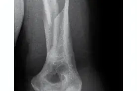 尴尬了！两小伙掰手腕比力气，竟然骨折了图片