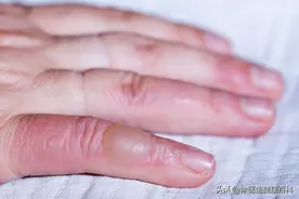 烫伤起水泡，挑破好还是不挑破好？烧伤科医生告诉你正确处理方式图片