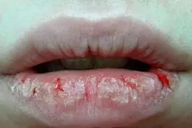 嘴唇干裂疼痛？3个中成药，健脾、滋阴、祛湿，拔除病根！图片