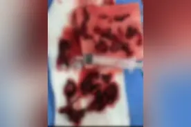 密密麻麻几百个，整整吸出“一盘”血栓！男子差点截肢：再也不敢了图片