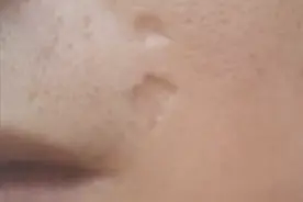 凹陷疤痕如何修复？生长因子有用吗？图片