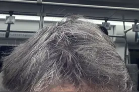 年纪轻轻就长白发？一截黑、一截白？当心！或是身体警告！好消息：能复黑（非染发）图片