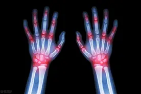 怎样判断痛风和类风湿？别再傻傻分不清！图片