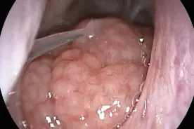 6岁孩子睡觉张口呼吸打呼噜，问题出在哪？小心腺样体肥大！图片