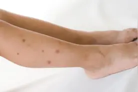 一到秋冬季节，皮肤就开始瘙痒，尤其是两条腿，你知道为什么吗？图片