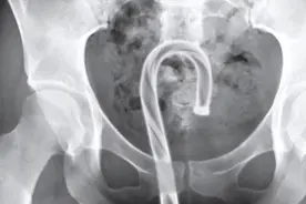 安徽一女子把异物塞进身体，疯狂喷气无法取出，连夜赶往医院求助图片