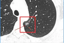 全错了？全都错了！众人皆醉我独醒？新冠后查出混合磨玻璃结节！图片