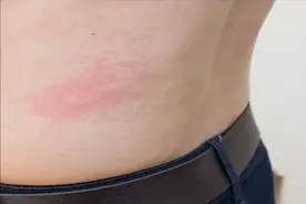 冬季皮肤发痒是过敏还是炎症？ 医生：洗澡方式要改改了图片