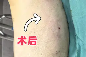 一个人做静脉曲张手术，体验如何？费用多少？术后恢复怎么样？图片