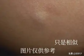 屁股上长了个硬包？有点疼又有点痒，什么情况？图片