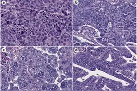 以例说 “法”| 术后复发两次，为子宫内膜癌患者“量体裁衣”，防治结合，筛查林奇综合征图片